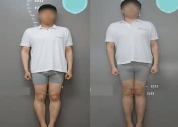 تحذير عاجل من عمليات تطويل القامة بعد هذا السن .. يحمل مخاطر كبيرة