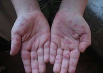 انتشار مرض التيفوئيد في مدارس مكة المكرمة .. حاتم المسعودي يكشف الحقيقة الكاملة