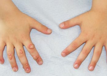 أسباب مرض السنط الجلدي وطرق علاجه ومنع انتقال العدوى